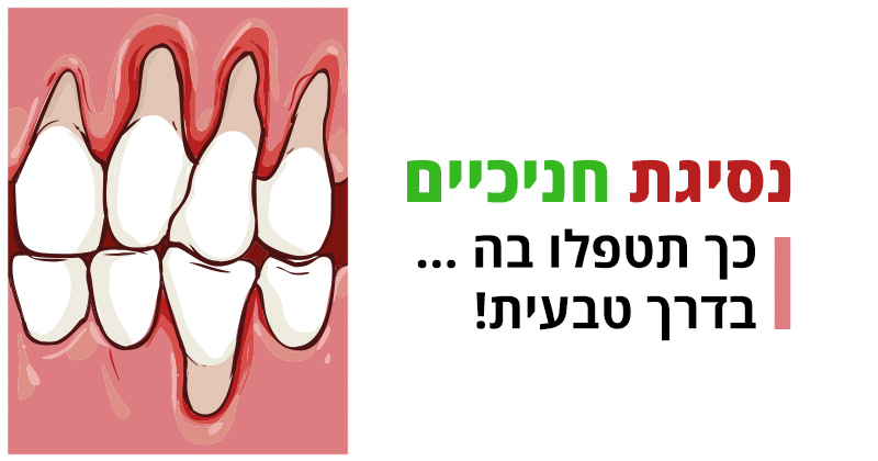 נסיגת חניכיים