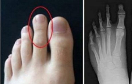 האם האצבע שלכם גדולה יותר מהבוהן?
