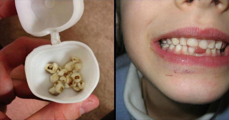 רופאי השיניים מזהירים: אל תזרקו את שיני החלב! הן יכולות להציל את חיי ילדיכם!
