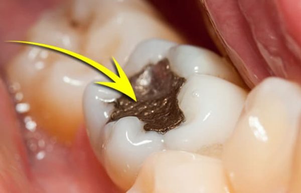 6 עובדות על סתימות אמלגם שיש לכם בשיניים