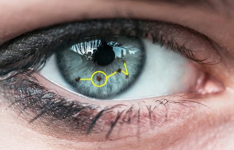 אם יש לכם כתם בקשתית העין כדאי שתדעו את זה