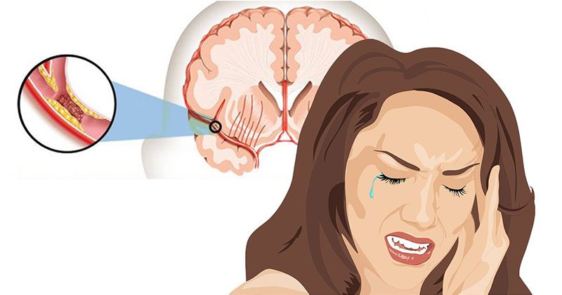9 תסמינים מוקדמים, המצביעים על כך שהיה לכם שבץ מוחי שקט