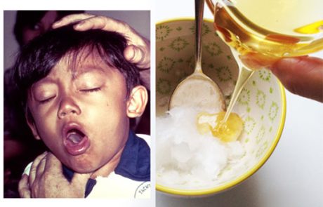 שילוב של שמן קוקוס ודבש יוצר תרופה רבת עוצמה שתעצור את השיעול שלכם באופן מיידי